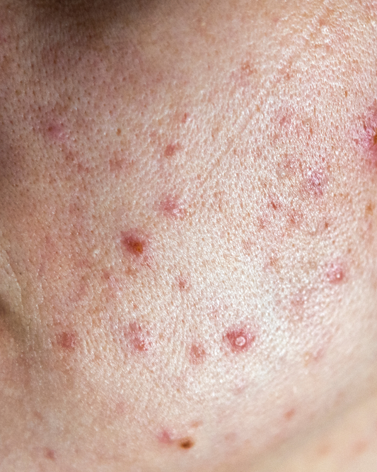 Acne Ormonale: Cause, Sintomi e Rimedi Naturali per Riequilibrare la Pelle